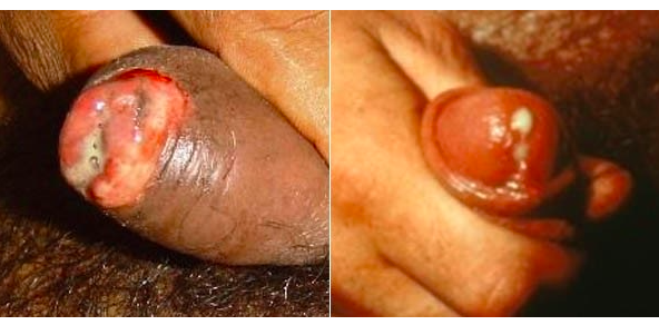 trieu-chung-lau-o-nam