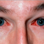 Bệnh Đau Mắt Đỏ, Nguyên Nhân & Phân Biệt